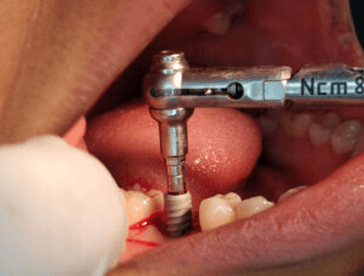 Implant Dentistry