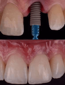 Implant Dentistry