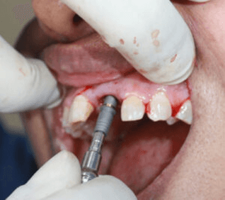 Implant dentistry