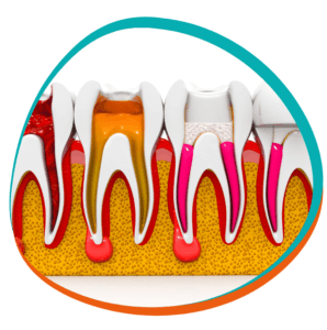 Root Canal Treatment