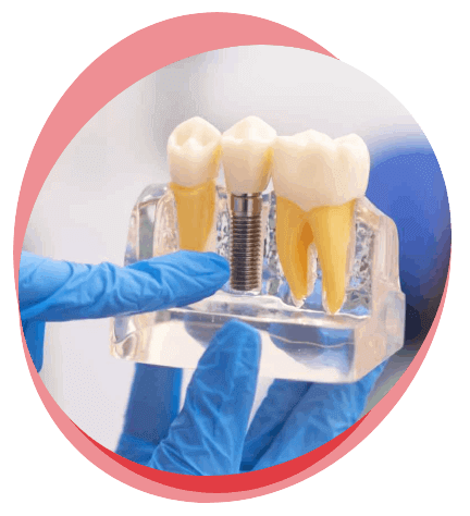 affordable dental implant treatment in hyderabad