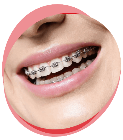 affordable painless dental braces treatment in hyderabad