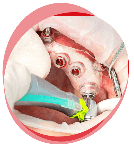 implant key hole surgery hyderabad - sree dental hospital