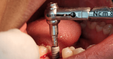 Implant Dentistry