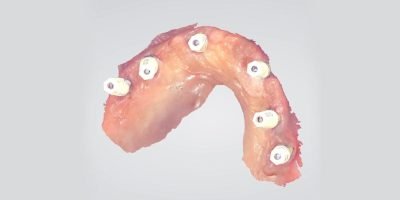 Implant Dentistry